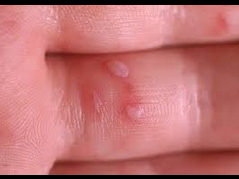 Sindrome mano pie boca. Virus Coxsackie