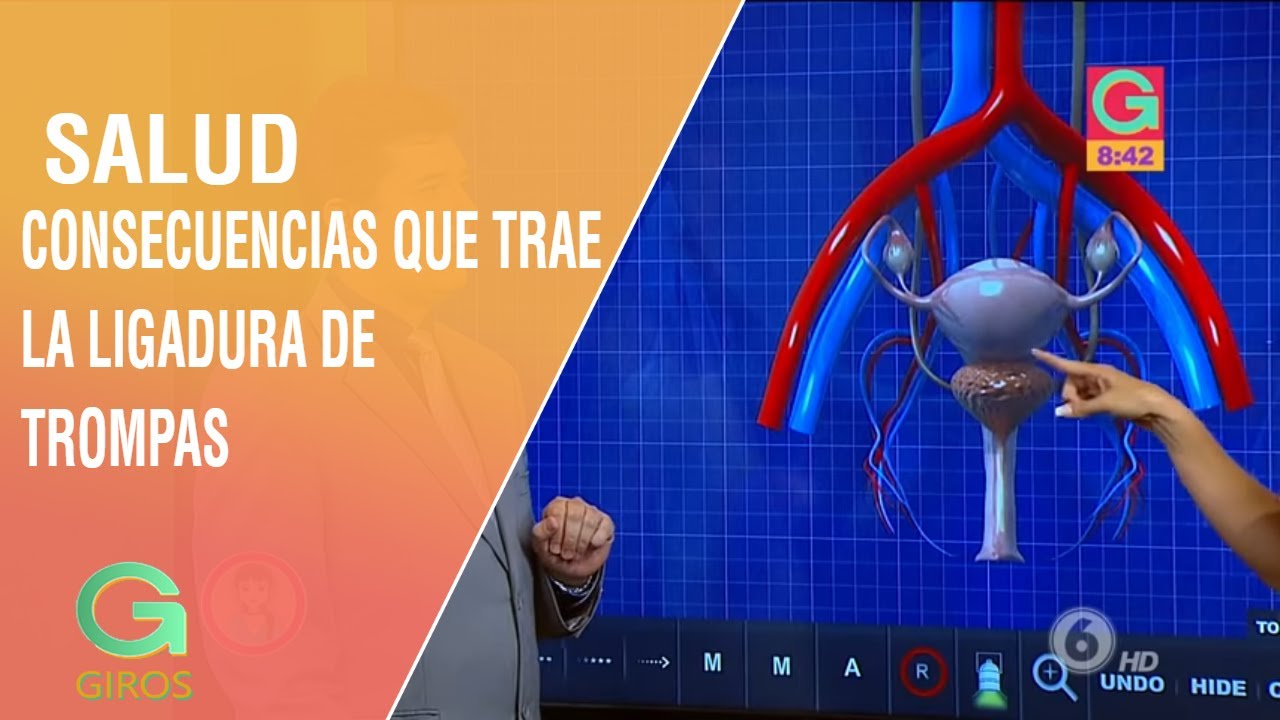 ¿Qué consecuencias trae la ligadura de trompas en una mujer? | Salud