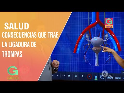 ¿Qué consecuencias trae la ligadura de trompas en una mujer? | Salud