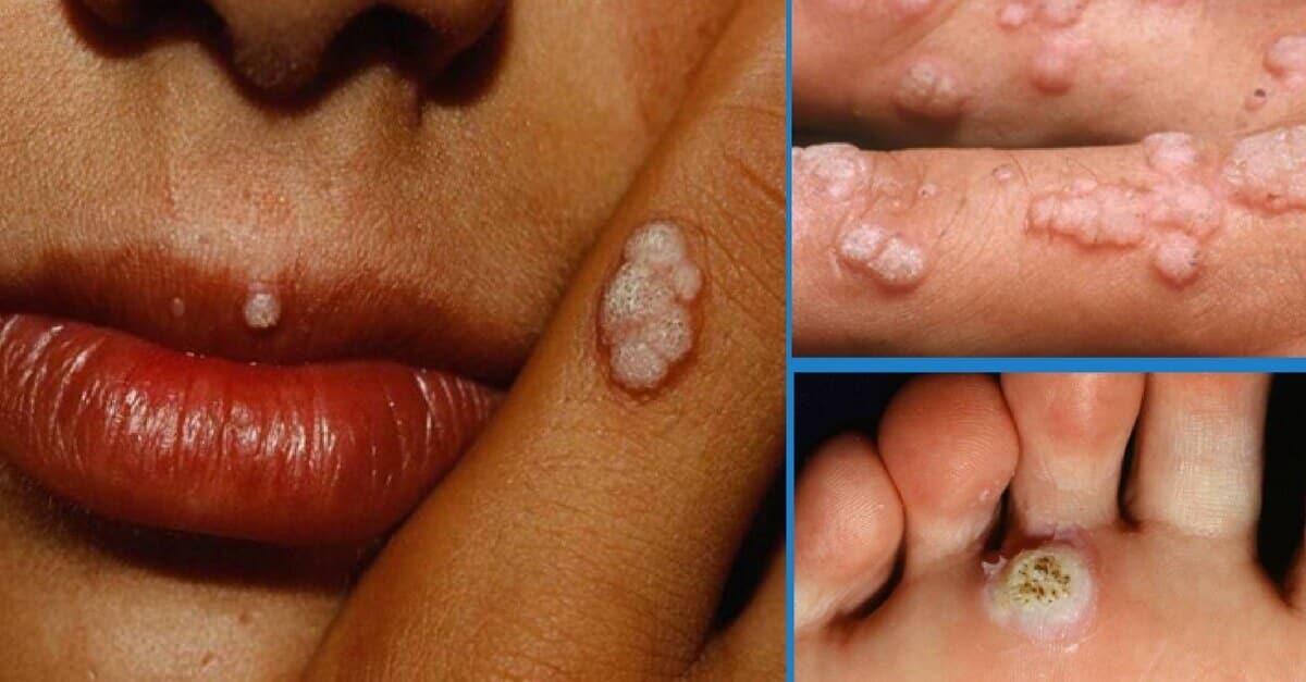 Sepa todo sobre el Virus del papiloma humano