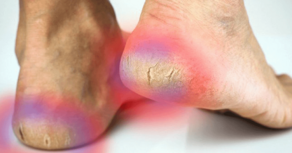 Diga adiós a las grietas en los pies, con el tratamiento