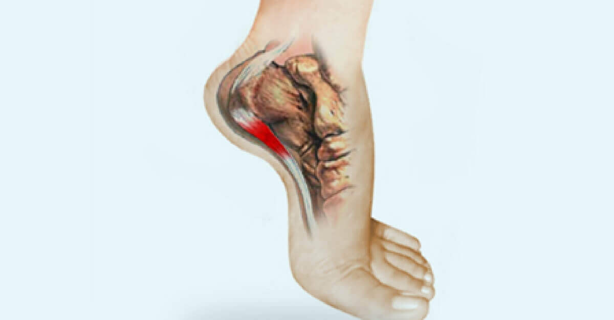 Conozca por qué le duelen la planta de los pies eConsejos