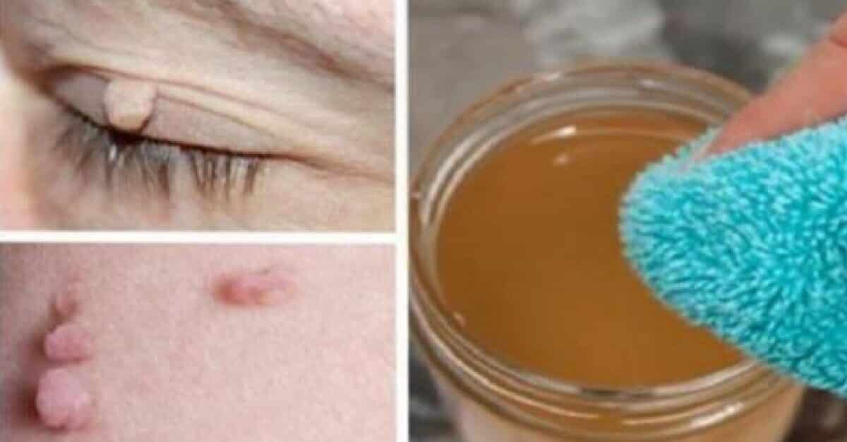 Trucos De La Abuela Para Quitar Verrugas