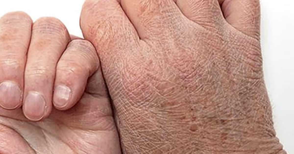 Piel muy seca ¿un signo de otras enfermedades? Piel muy seca ¿un signo de otras enfermedades?