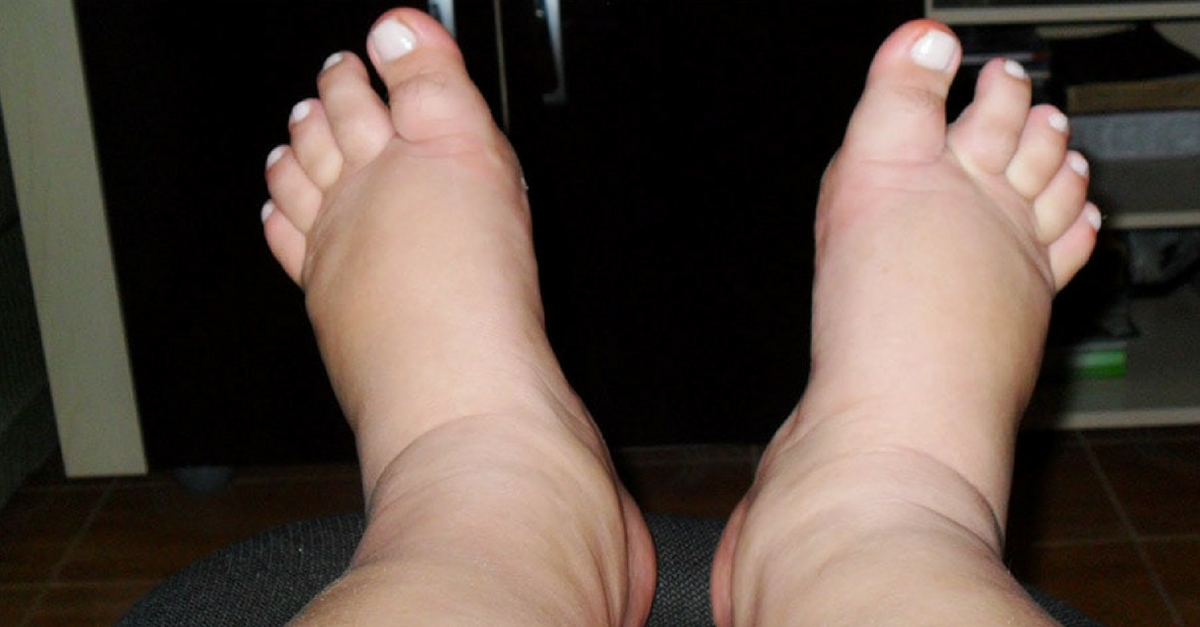 Pies hinchados causas y tratamientos