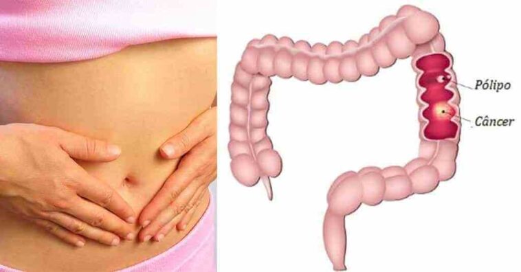 pólipos intestinales