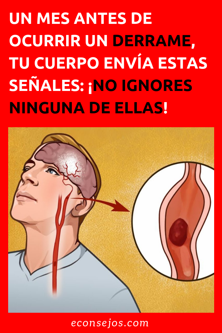 Accidente cerebrovascular