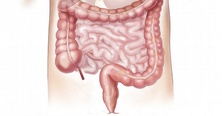 Enfermedad de Crohn