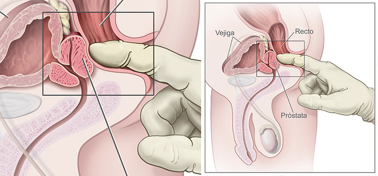 Eyaculacion frecuente reduce el riesgo de cancer de prostata examen