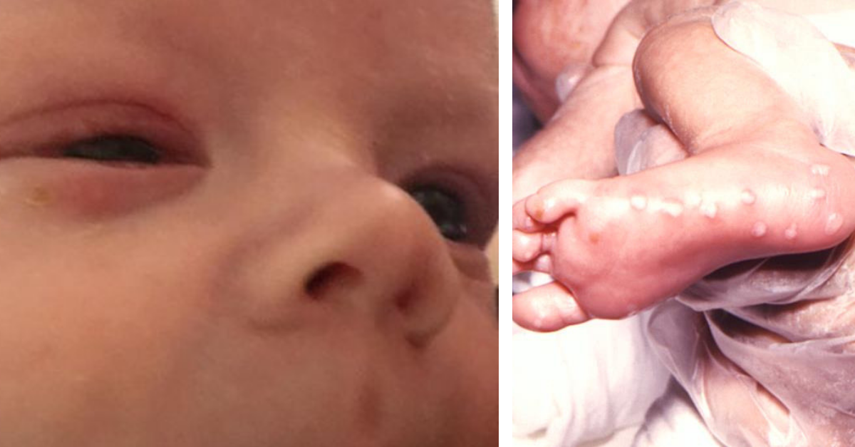 Herpes neonatal qué es, síntomas y cómo prevenirlo