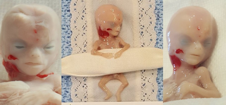 Mama comparte fotos de su feto abortado de 14 semanas Aborto