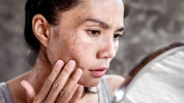 El melasma