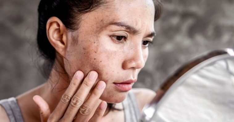 El melasma