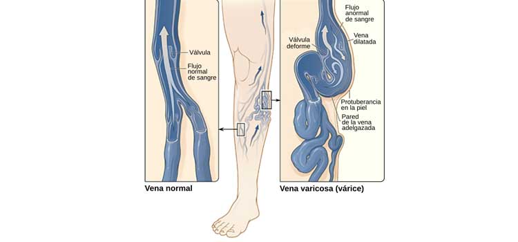 Personas altas son mas propensas a varices valvula