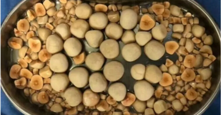 Retiran más de 100 piedras de la vejiga a un anciano