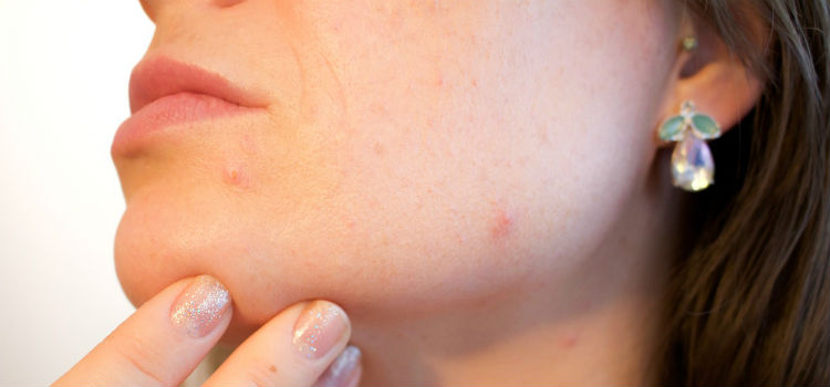 enfermedades de la piel acne