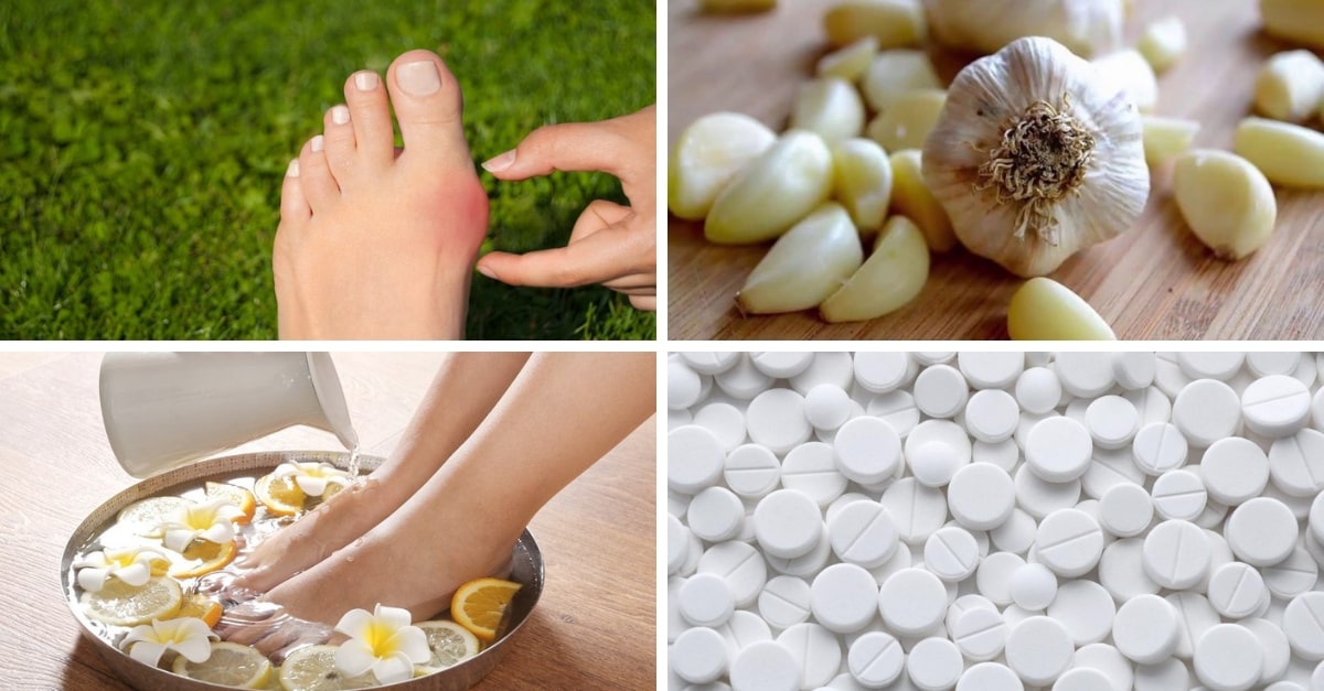 14 Remedios caseros para eliminar los callos