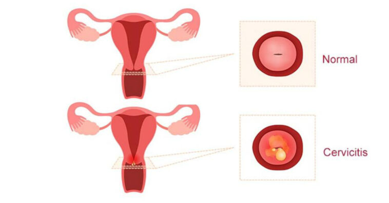 cervicitis