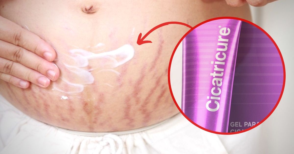 ¿Funciona Cicatricure para las estrías? Descubre lo que promete el producto