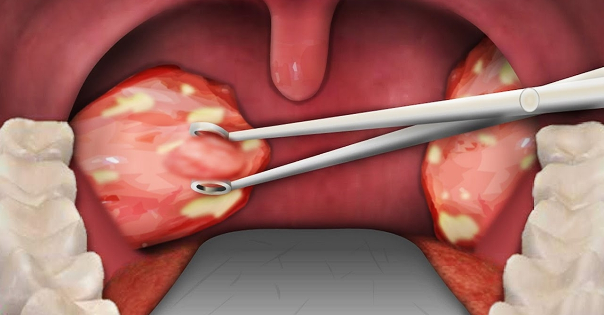 Retirar las amígdalas aumenta el riesgo de enfermedades respiratorias