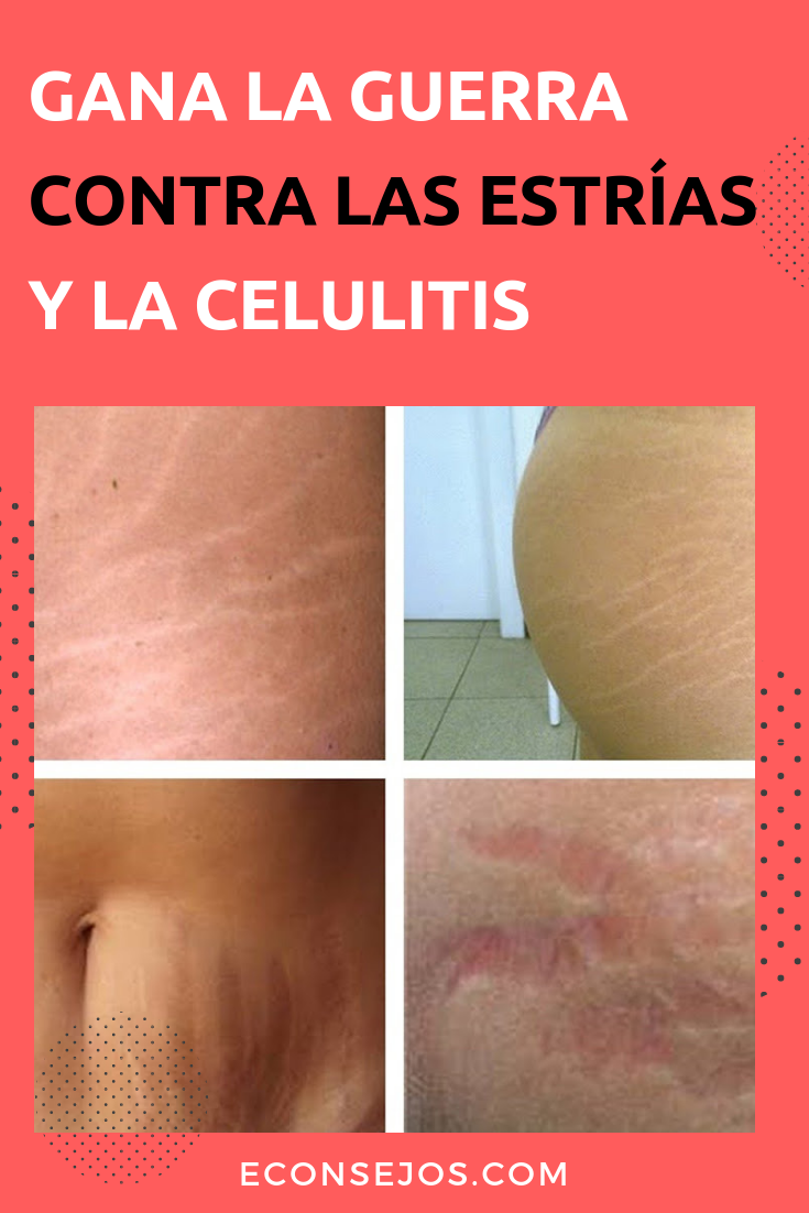 Cómo combatir la celulitis y las estrías