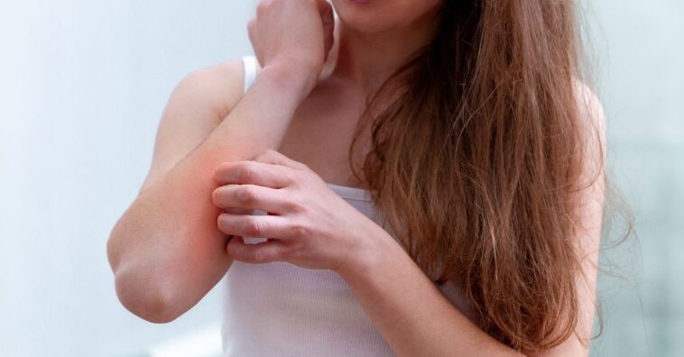 Alergia al agua