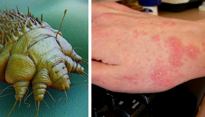 Sarna: síntomas, qué es y qué tratamiento existe para curarla