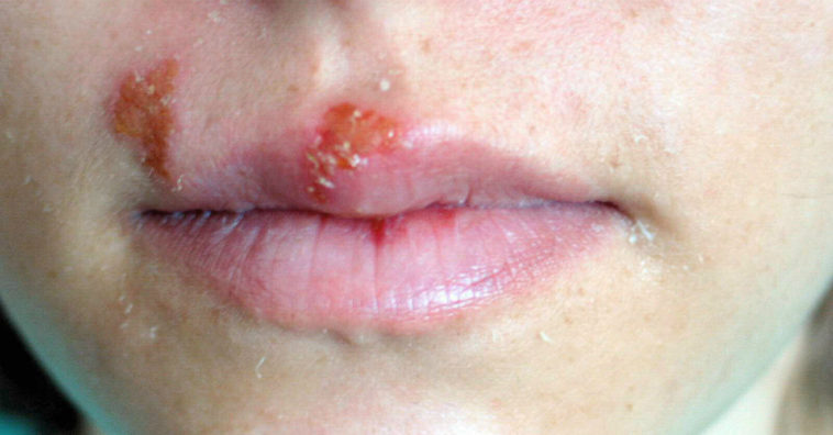 curar el herpes labial