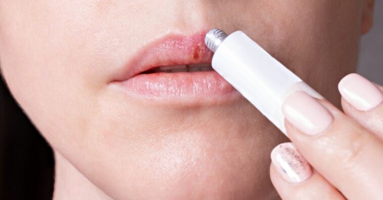 Cómo tratar el herpes labial