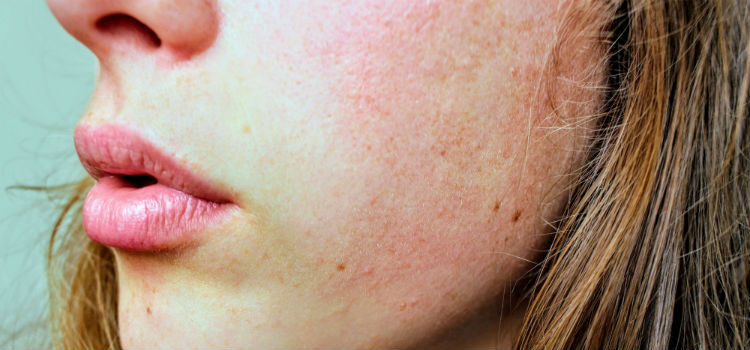 enfermedades de la piel dermatitis
