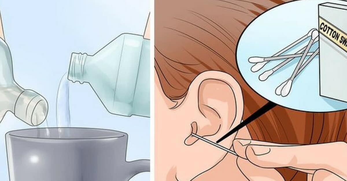 2 Ingredientes para eliminar la cera del oído y las infecciones