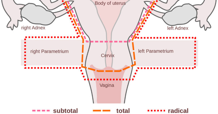 histerectomía
