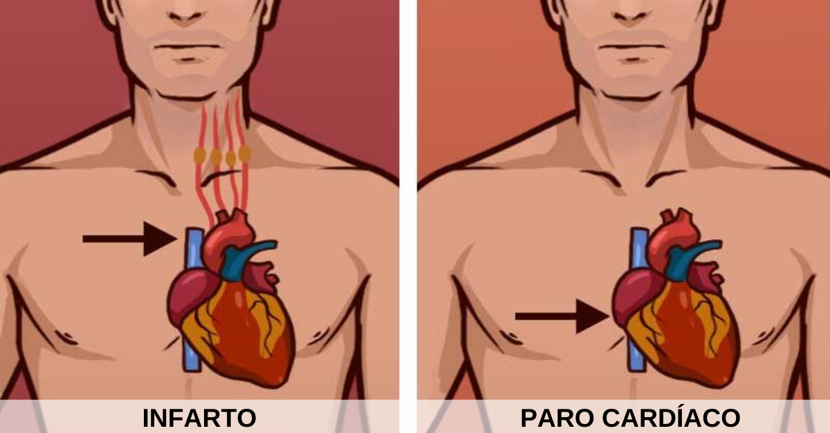 ¿Es lo mismo un infarto y un paro cardíaco?