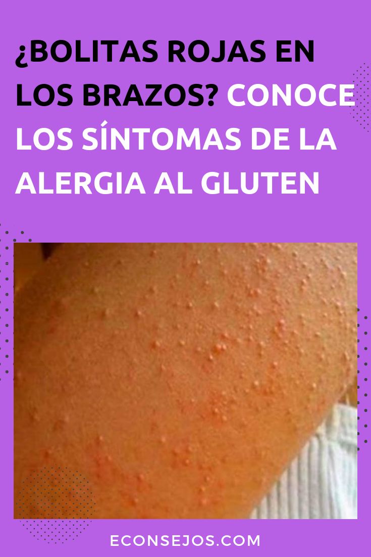 Intolerancia al gluten