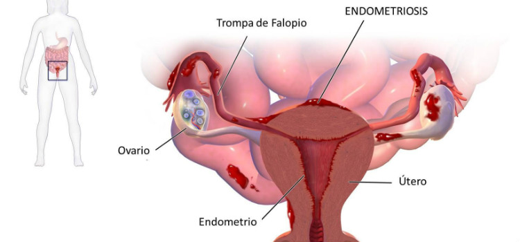 la endometriosis