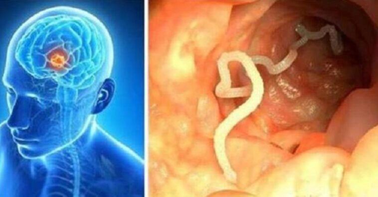 alimentos contaminados pueden traer gusanos al cerebro