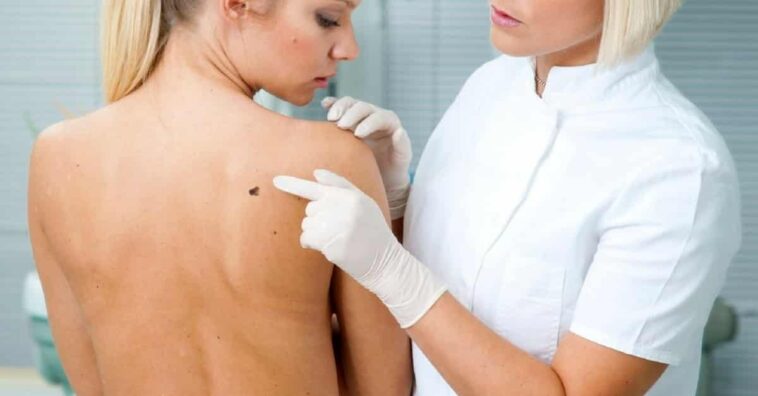 identificar un melanoma