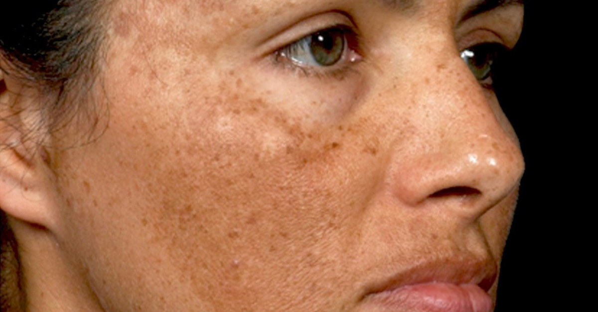 Brown Spots On Face Melasma