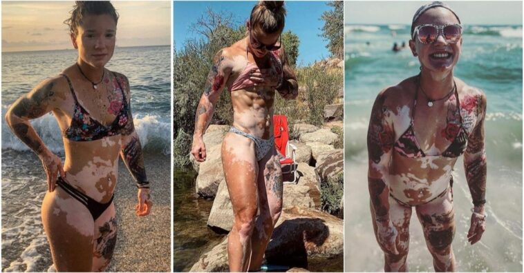 mujer con vitíligo inspira a miles a que superen los problemas de imagen corporal