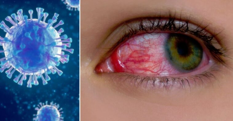 ojos rojos: un síntoma del coronavirus