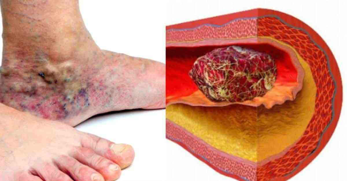 Conoce cómo prevenir la trombosis con estos 5 consejos