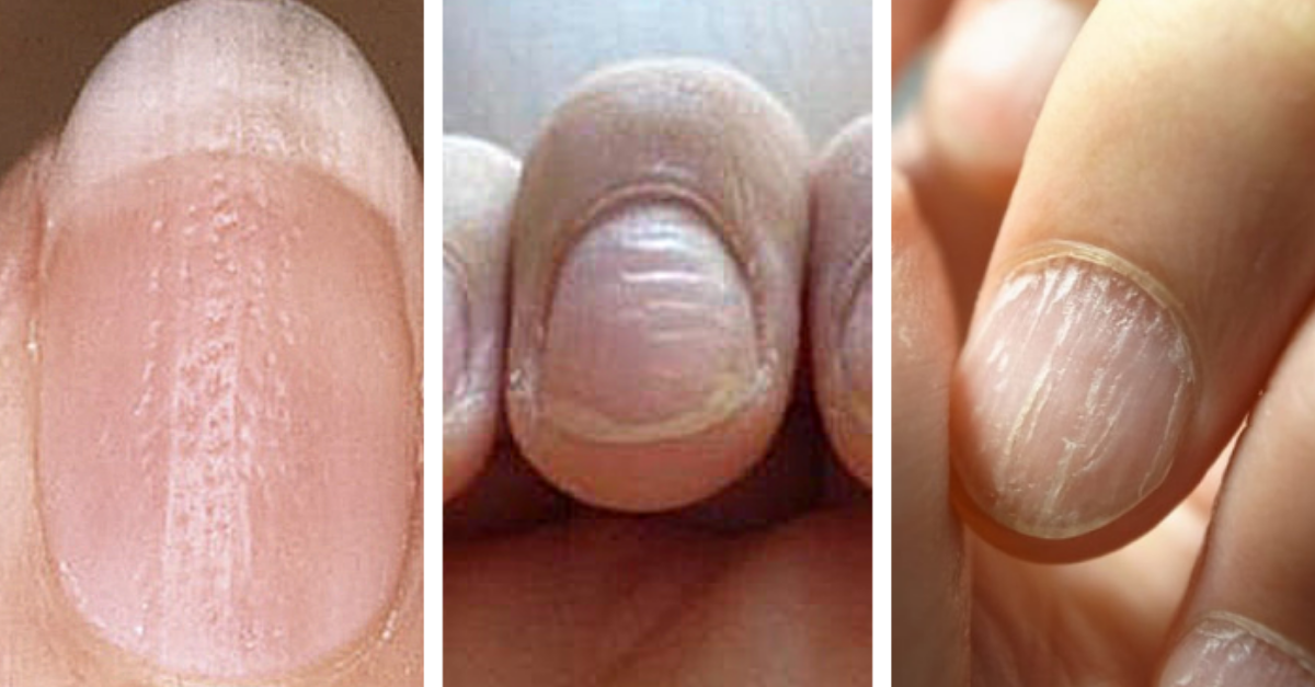 uñas que se rompen en vertical