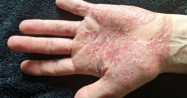 Psoriasis