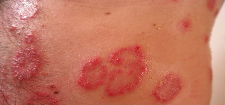 enfermedades de la piel psoriasis