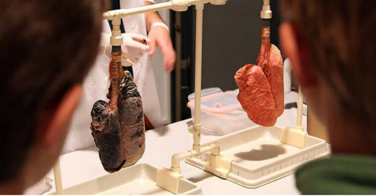 pulmones de alguien que ha fumado durante 30 años