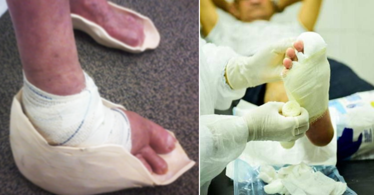 Pie diabético descubre qué es y cómo tratarlo