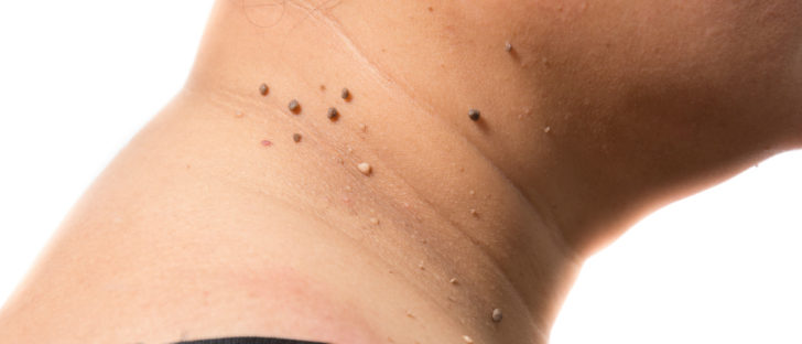 quitar las verrugas del cuello