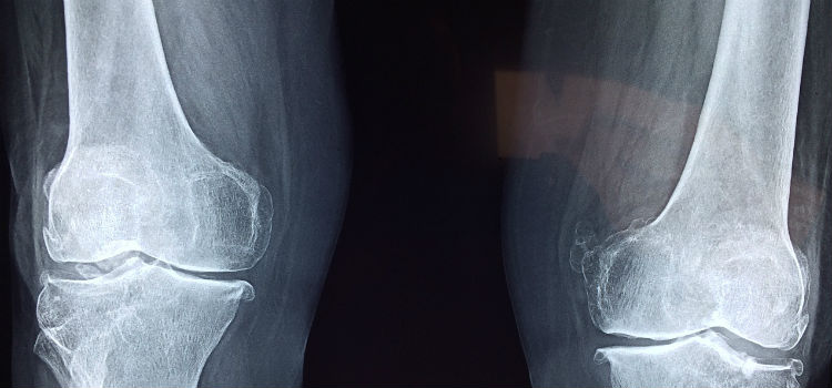 osteoporosis tratamiento