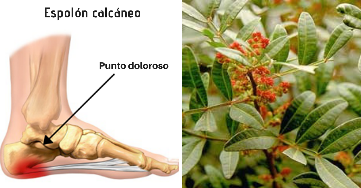 Remedios caseros para el espolon calcaneo