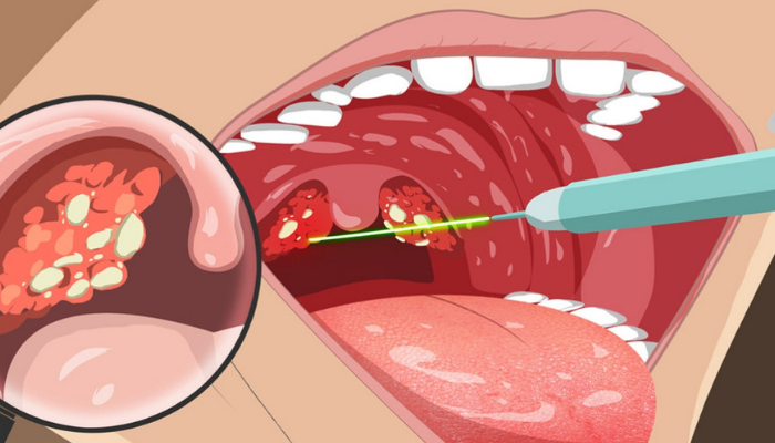 como quitar la infeccion de garganta rapido